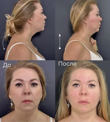 BOTOX 360 — результат работы — фото 1