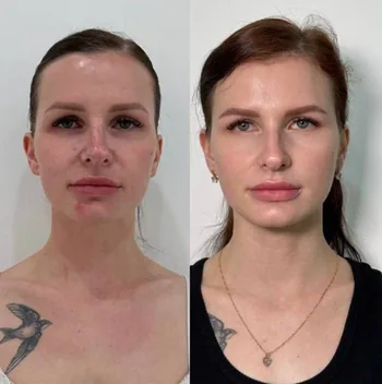 BOTOX 360 — результат работы — фото 2