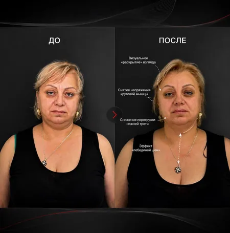 BOTOX 360 — результат работы — фото 3