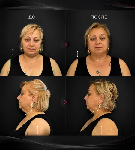 BOTOX 360 — результат работы — фото 4