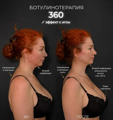 BOTOX 360 — результат работы — фото 5