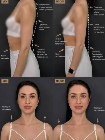 BOTOX 360 — результат работы — фото 6